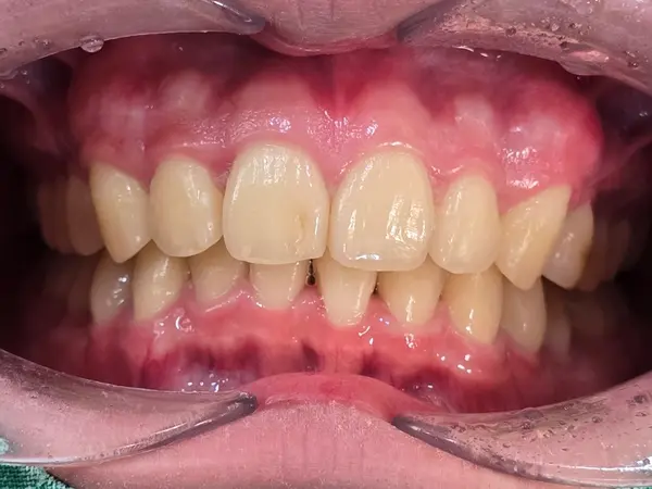 Post-treatment result
