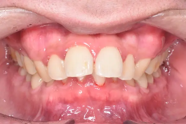 Initial state of patient teeth