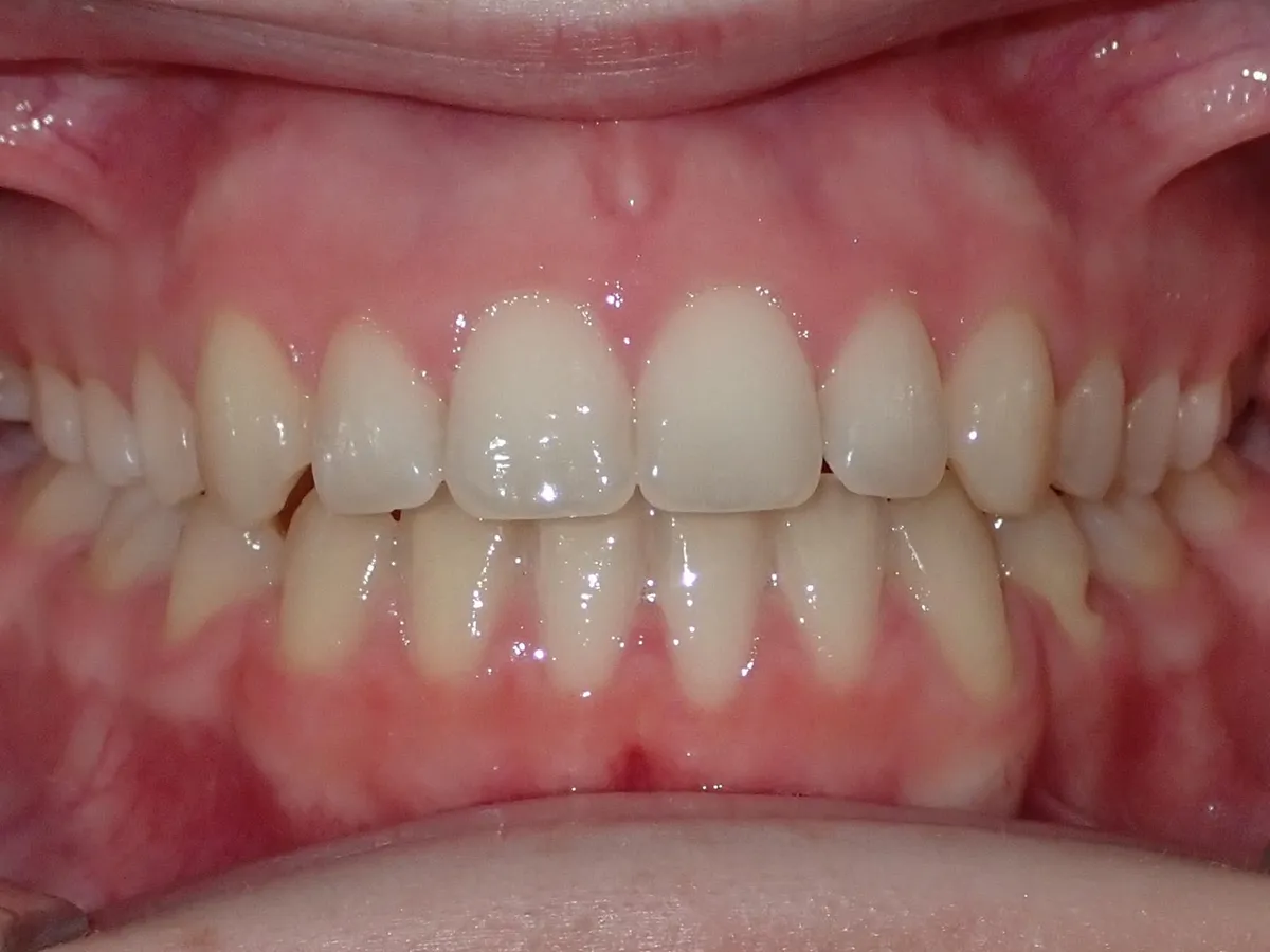 Frontal