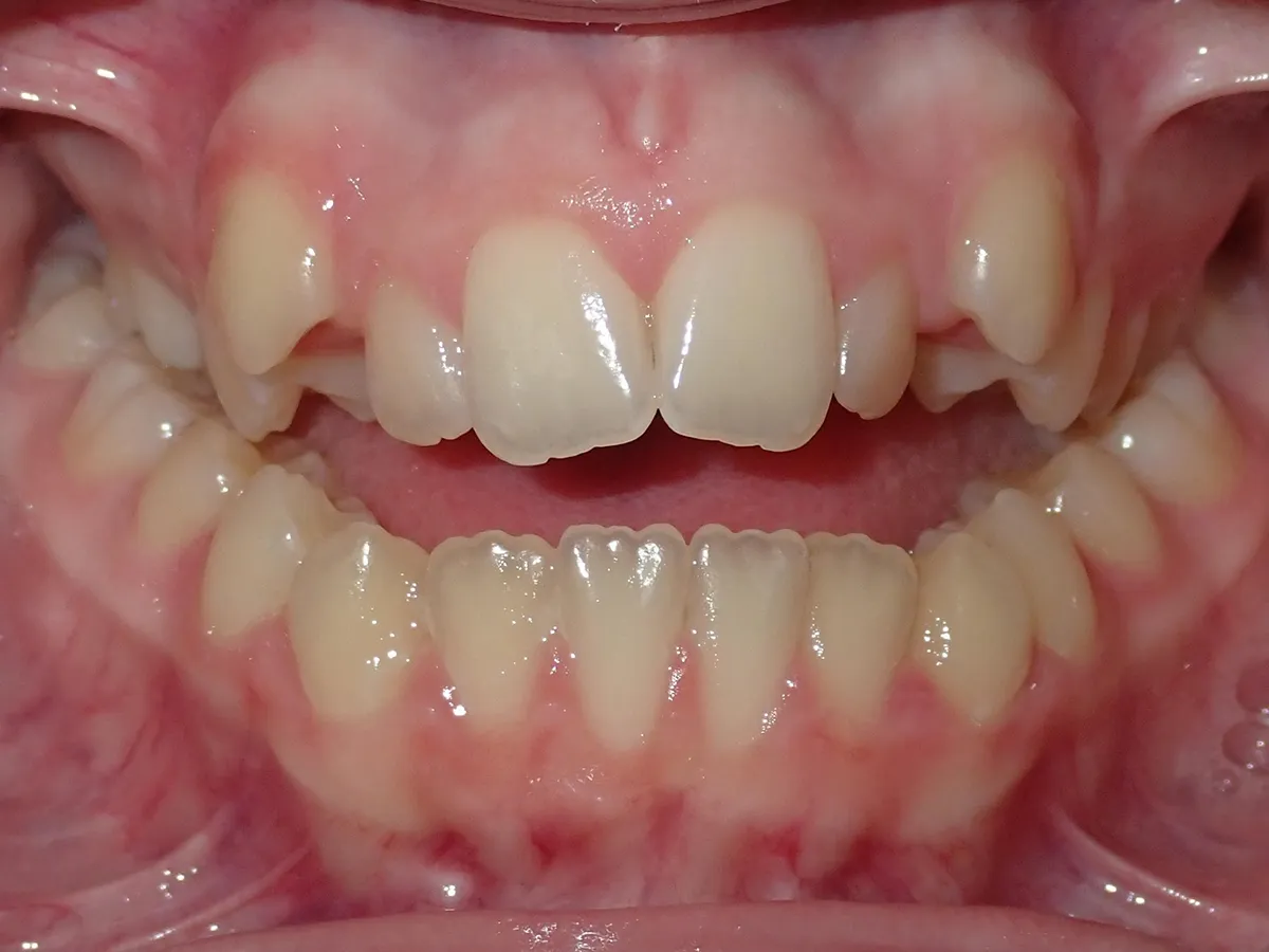 Frontal