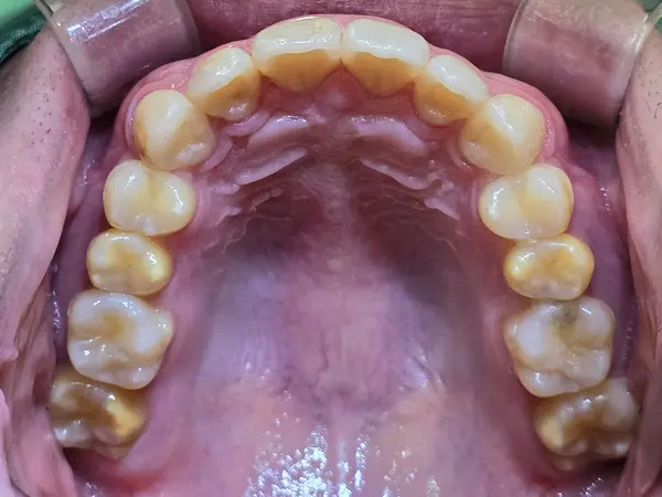 Post-treatment result