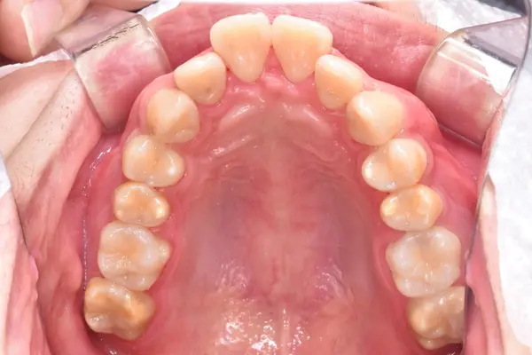 Initial state of patient teeth