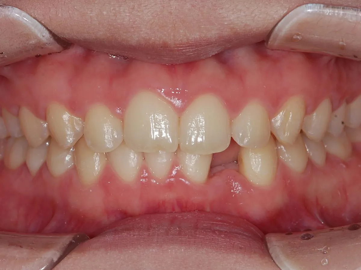 Frontal
