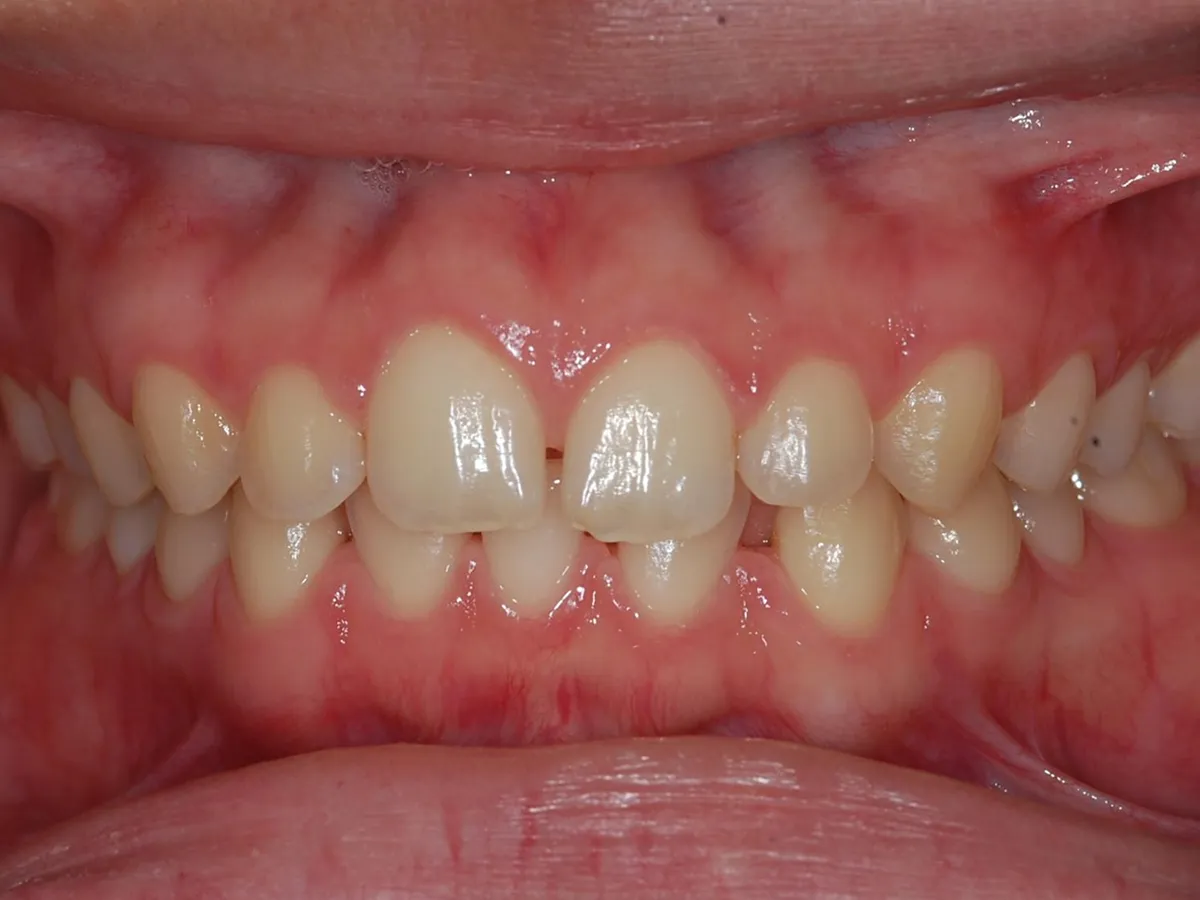 Frontal