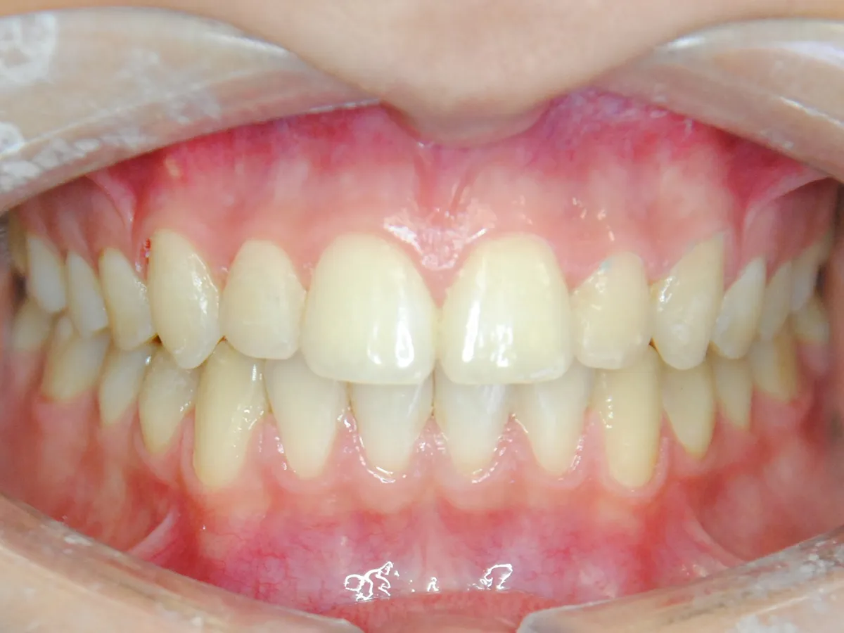 Frontal