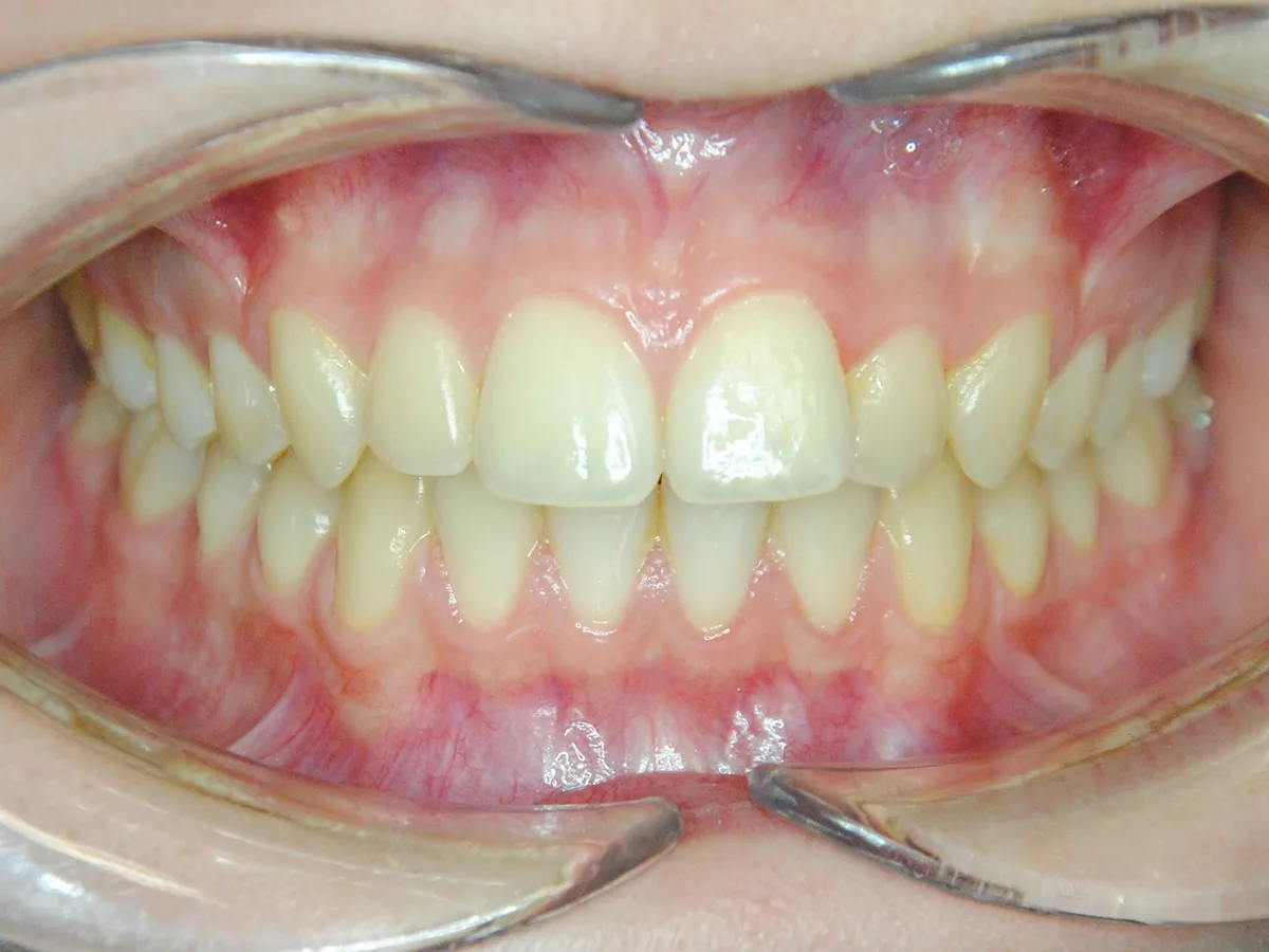 Frontal