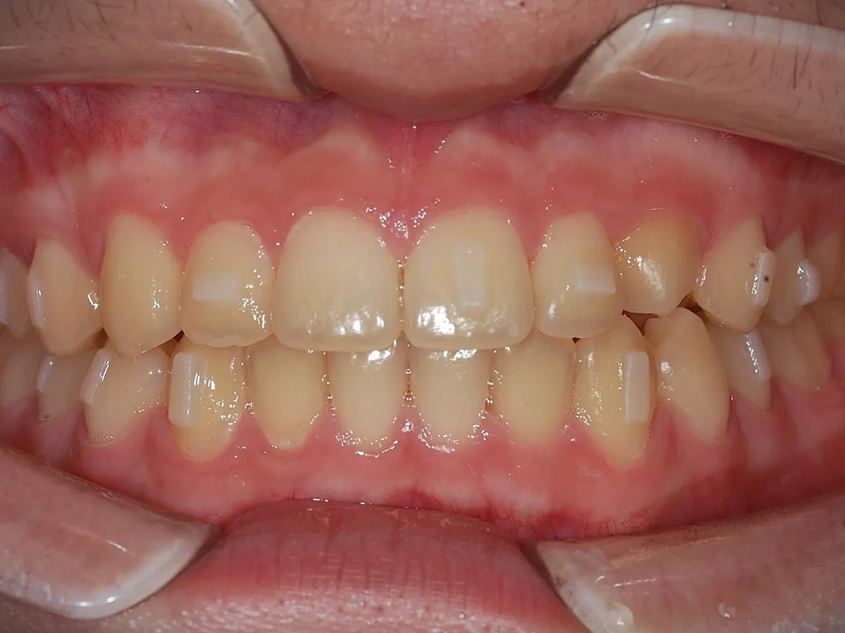 Frontal