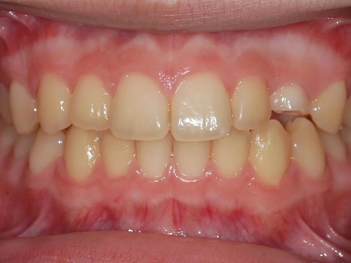 Frontal