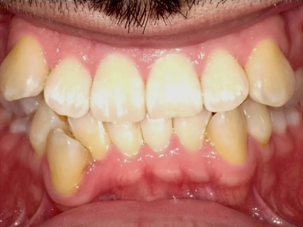 Frontal