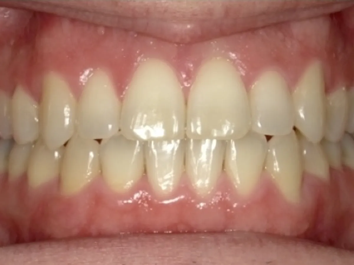 Frontal