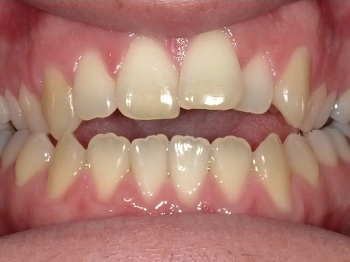 Frontal