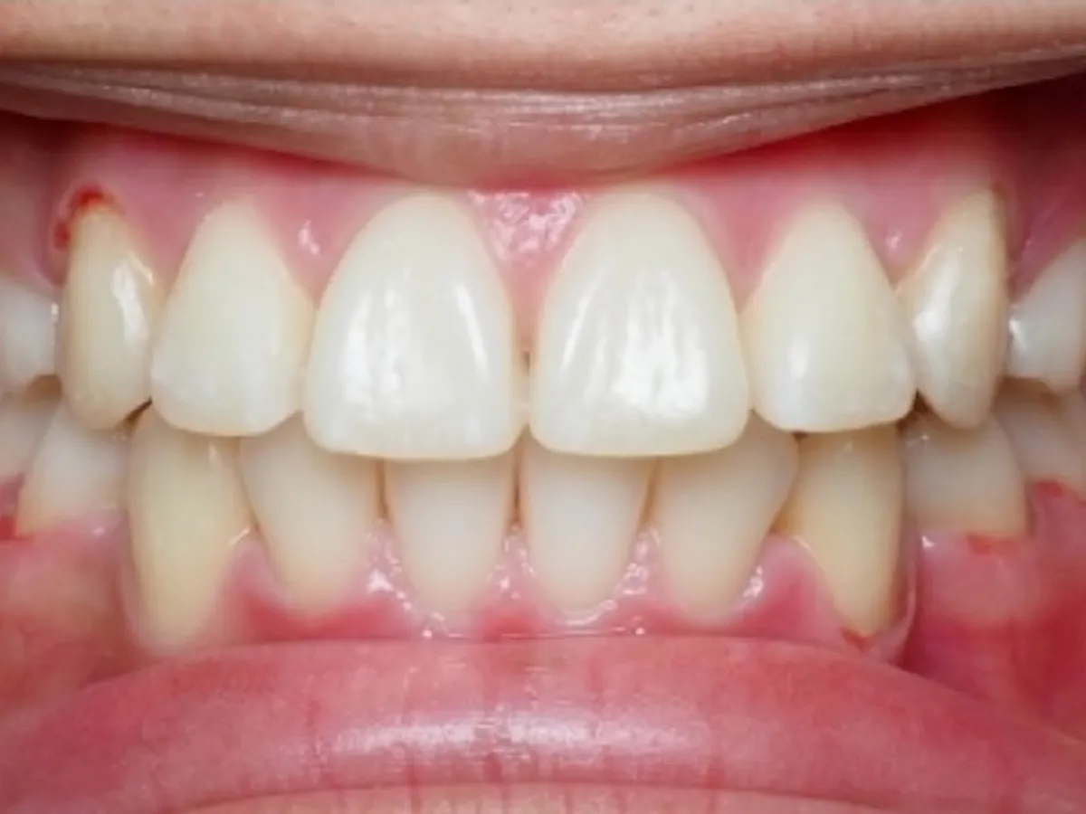 Frontal