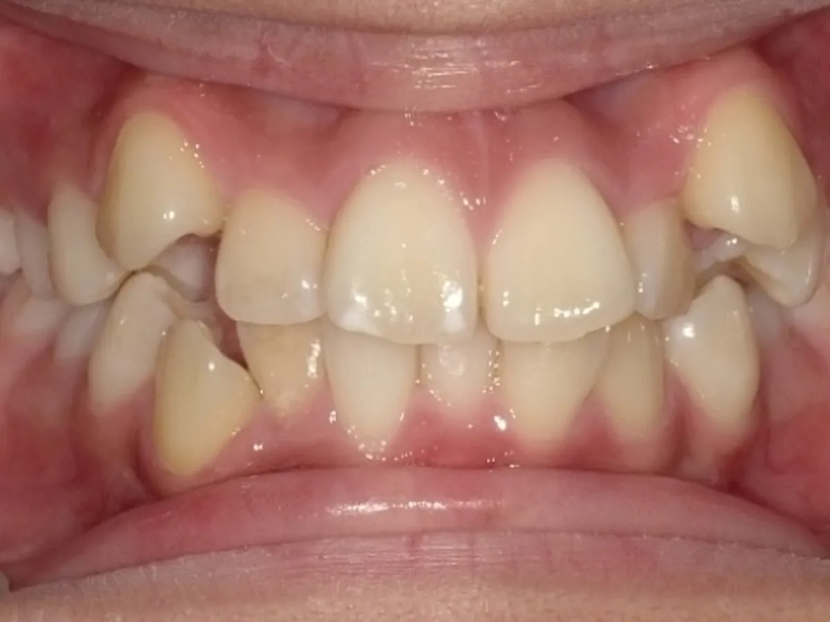 Frontal