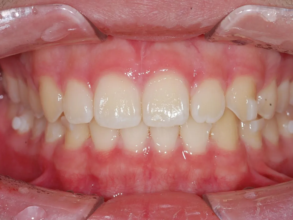 Frontal