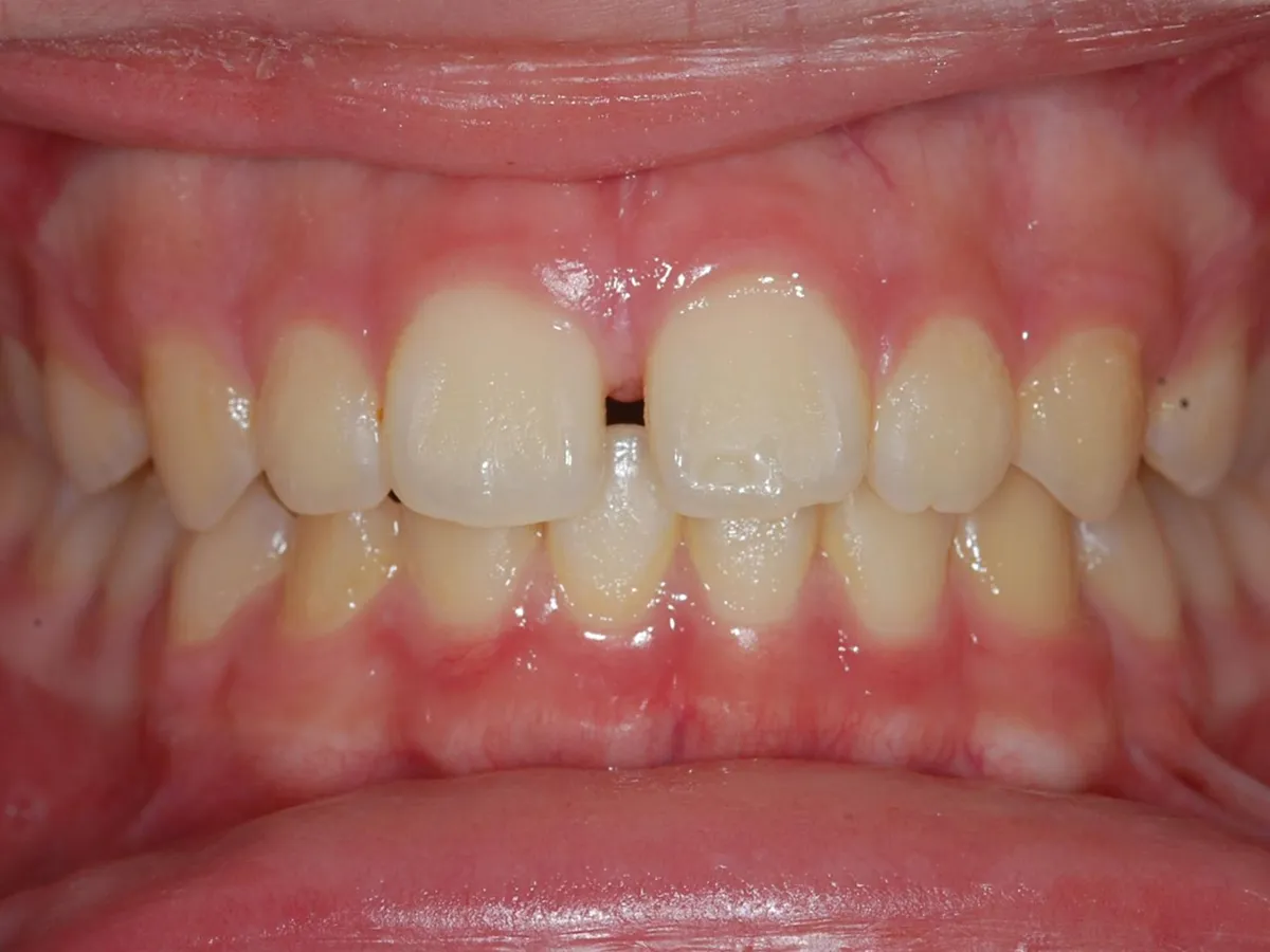 Frontal