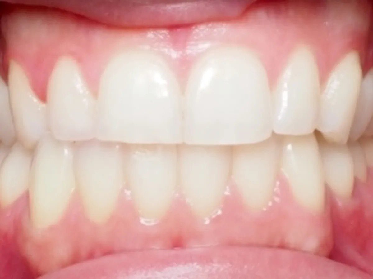 Frontal