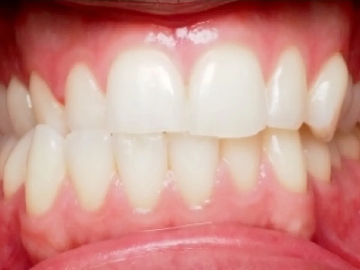 Frontal