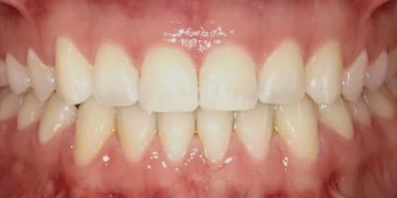 After image of teeth