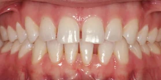 Before image of teeth