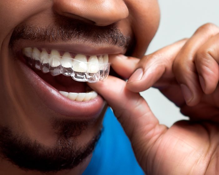 man pulling out clear aligners