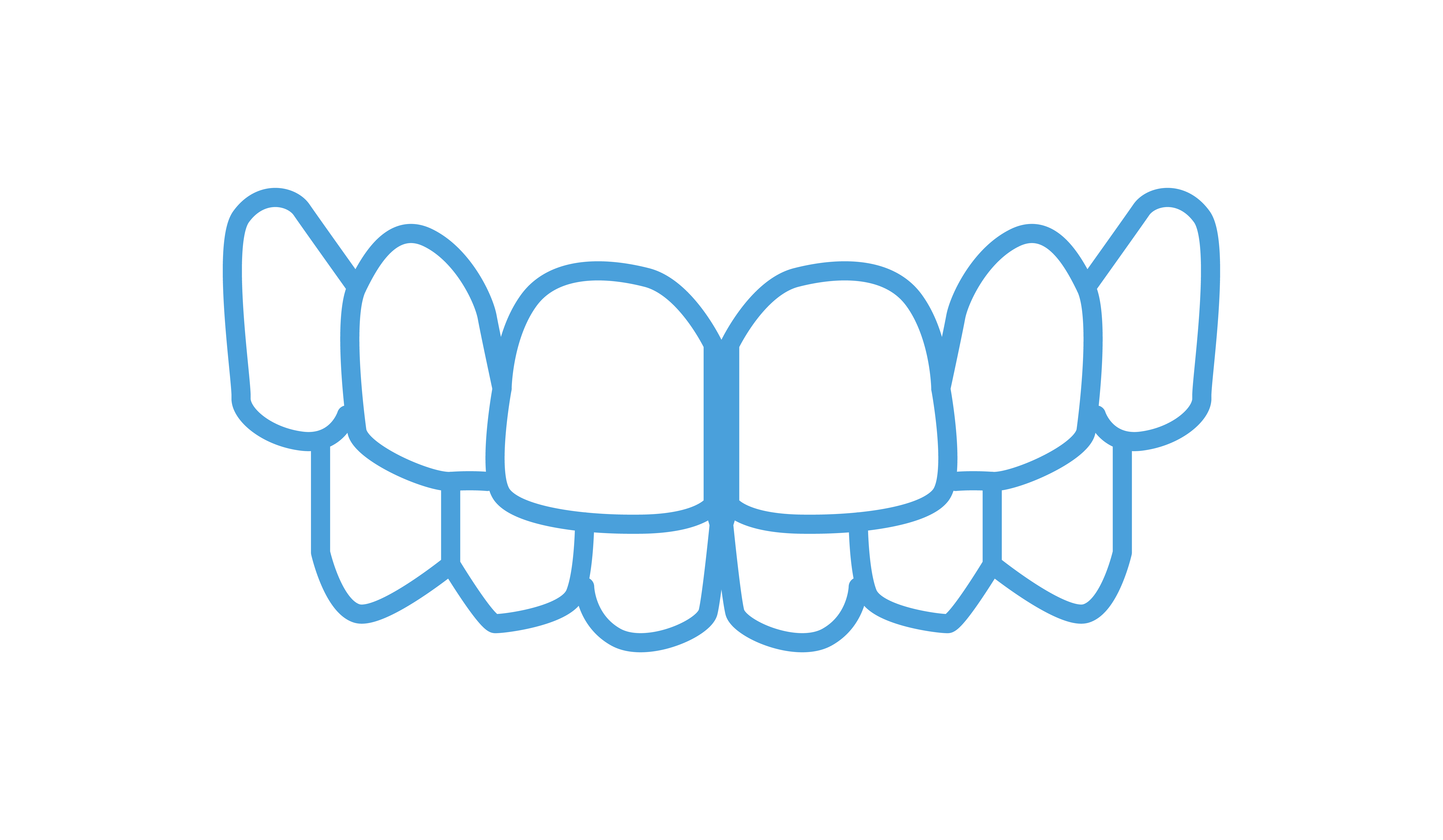 What is an Overbite and How is it Corrected? - Westermeier Martin Dental  Care