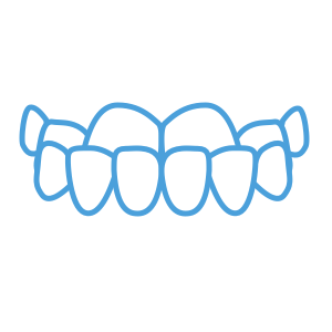 <strong>Underbite</strong> </br> <p>Bottom teeth protrude over top teeth.</br></br></p>